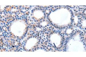 Immunohistochemistry of paraffin-embedded Human thyroid cancer using HCN1 Polyclonal Antibody at dilution of 1:50 (HCN1 Antikörper)