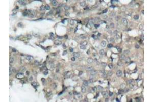 Immunohistochemistry analyzes of MEK1/2 antibody in paraffin-embedded human breast carcinoma tissue. (MEK1 Antikörper)