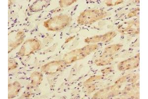 Immunohistochemistry of paraffin-embedded human gastric cancer using ABIN7166195 at dilution of 1:100 (TOB2 Antikörper  (AA 1-70))