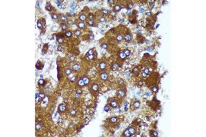 Immunohistochemistry of paraffin-embedded Human liver cancer using PIGU Rabbit pAb (ABIN7269291) at dilution of 1:100 (40x lens). (PIGU Antikörper)