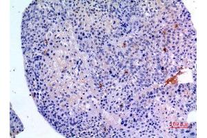 Immunohistochemistry (IHC) analysis of paraffin-embedded Human Liver Cancer, antibody was diluted at 1:100.