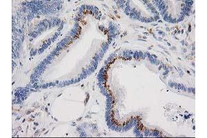 Immunohistochemical staining of paraffin-embedded Adenocarcinoma of Human colon tissue using anti-IRF6 mouse monoclonal antibody. (IRF6 Antikörper)