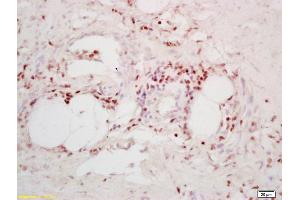 Formalin-fixed and paraffin embedded human colon carcinoma labeled with Anti-TPD52/Prostate and colon associated protein Polyclonal Antibody, Unconjugated (ABIN720745) at 1:200 followed by conjugation to the secondary antibody and DAB staining (TPD52 Antikörper  (AA 141-190))
