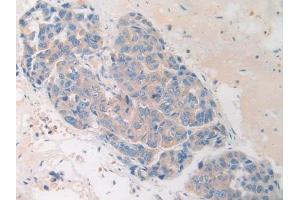 IHC-P analysis of Human Breast cancer Tissue, with DAB staining. (HAND1 Antikörper  (AA 1-215))