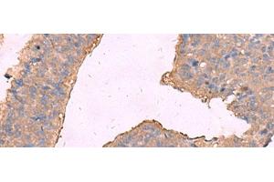 Immunohistochemistry of paraffin-embedded Human liver cancer tissue using KCNN2 Polyclonal Antibody at dilution of 1:65(x200) (KCNN2 Antikörper)