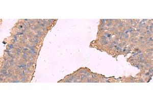 Immunohistochemistry of paraffin-embedded Human liver cancer tissue using KCNN2 Polyclonal Antibody at dilution of 1:65(x200)