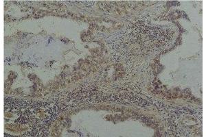 Immunohistochemical analysis of paraffin-embedded Human Lung Caricnoma using Phosphoserine Mouse mAb diluted at 1:200. (Phosphoserine Antikörper)