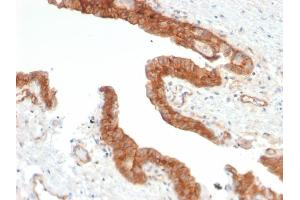 Formalin-fixed, paraffin-embedded human Prostate Carcinoma stained with CD73 Mouse Monoclonal Antibody (NT5E/2503). (CD73 Antikörper)