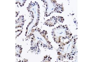 Immunohistochemistry of paraffin-embedded human thyroid cancer using [KO Validated] PDCD4 Rabbit pAb (ABIN3023387, ABIN3023388, ABIN3023389 and ABIN1681284) at dilution of 1:25 (40x lens). (PDCD4 Antikörper  (AA 1-260))