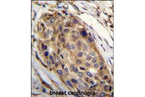 SSH3 Antibody immunohistochemistry analysis in formalin fixed and paraffin embedded human breast carcinoma followed by peroxidase conjugation of the secondary antibody and DAB staining. (SSH3 Antikörper  (C-Term))