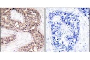 Immunohistochemistry analysis of paraffin-embedded human breast carcinoma tissue, using G3BP-1 (Ab-232) Antibody. (G3BP1 Antikörper  (AA 199-248))