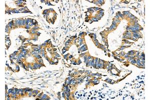 ABIN6260901 and ABIN6276686 at 1/100 staining Human colorectal cancer by IHC-P. (Clusterin Antikörper  (Internal Region))