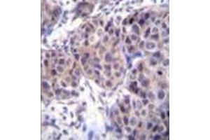 Formalin fixed and paraffin embedded human breast carcinoma reacted with Dishevelled-3 / DVL3 Antibody (C-term) followed by peroxidase conjugation of the secondary antibody and DAB staining. (DVL3 Antikörper  (C-Term))