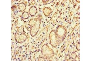 Immunohistochemistry of paraffin-embedded human gastric cancer using ABIN7166087 at dilution of 1:100 (S1G (AA 1-66) Antikörper)