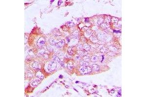 Immunohistochemical analysis of CapG staining in human lung cancer formalin fixed paraffin embedded tissue section. (CAPG Antikörper)