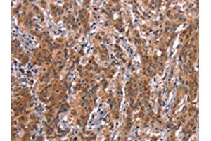 The image on the left is immunohistochemistry of paraffin-embedded Human gastic cancer tissue using ABIN7190640(FDCSP Antibody) at dilution 1/25, on the right is treated with synthetic peptide. (FDCSP Antikörper)