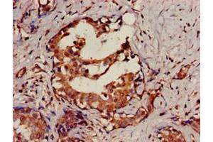 Immunohistochemistry of paraffin-embedded human breast cancer using ABIN7168837 at dilution of 1:100 (SENP2 Antikörper  (AA 138-324))