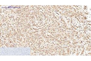 Immunohistochemistry of paraffin-embedded Human breast cancer tissue using Oct-1/2 Monoclonal Antibody at dilution of 1:200. (Oct-1/2 Antikörper)