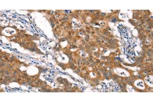 Immunohistochemistry of paraffin-embedded Human gasrtic cancer tissue using CYLD Polyclonal Antibody at dilution 1:35 (CYLD Antikörper)