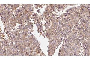 ABIN6274569 at 1/100 staining Human liver cancer tissue by IHC-P. (5HT1B Receptor Antikörper  (Internal Region))