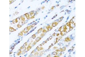 Immunohistochemistry of paraffin-embedded Human gastric cancer using NDUFA5 Polyclonal Antibody at dilution of 1:100 (40x lens). (NDUFA5 Antikörper)