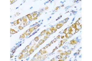 Immunohistochemistry of paraffin-embedded Human gastric cancer using NDUFA5 Polyclonal Antibody at dilution of 1:100 (40x lens). (NDUFA5 Antikörper)