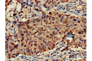Immunohistochemistry of paraffin-embedded human lung cancer using ABIN7143032 at dilution of 1:100 (FAM17A (AA 1-144) Antikörper)