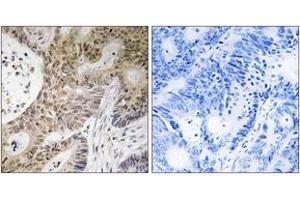Immunohistochemistry analysis of paraffin-embedded human colon carcinoma tissue, using PRPF6 Antibody. (PRP6/ANT-1 Antikörper  (AA 747-796))