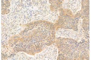 ABIN6264686 and ABIN6272906 at 1/100 staining Human lung cancer by IHC-P.