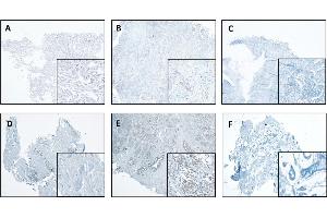 CTSL expression in normal and tumor tissues of the lung and breast. (Cathepsin L Antikörper  (AA 114-288))