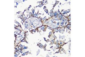 Immunohistochemistry of paraffin-embedded human lung cancer using MMP16 antibody (ABIN6132356, ABIN6143906, ABIN6143907 and ABIN6214654) at dilution of 1:100 (40x lens).
