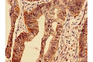 Immunocytochemistry analysis of human colon cancer using ABIN7172795 at dilution of 1:100 (Transferrin Receptor Antikörper  (AA 94-754))