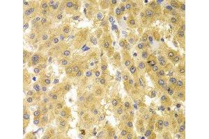 Immunohistochemistry of paraffin-embedded Human liver cancer using GMNN Polyclonal Antibody at dilution of 1:100 (40x lens).