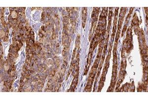 ABIN6267145 at 1/100 staining Human thyroid cancer tissue by IHC-P. (GRIN2B Antikörper  (pSer1284))