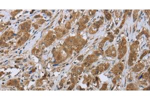Immunohistochemistry of paraffin-embedded Human breast cancer tissue using CLPS Polyclonal Antibody at dilution 1:45 (CLPS Antikörper)