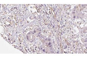 ABIN6273953 at 1/100 staining Human liver cancer tissue by IHC-P. (NPY4R Antikörper  (N-Term))