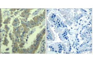 Immunohistochemical analysis of paraffin-embedded human lung carcinoma tissue using MARCKS (phospho-Ser170) Antibody (E011535). (MARCKS Antikörper  (pSer170))