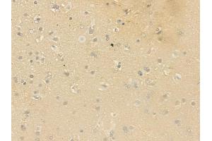 ABIN6264565 and ABIN6279732 at 1/100 staining human glioblastoma by IHC-P. (RAB23 Antikörper  (C-Term))