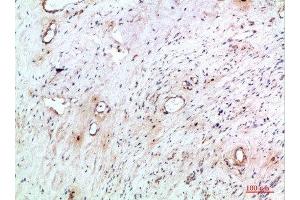 Immunohistochemical analysis of paraffin-embedded human-cervical-cancer, antibody was diluted at 1:200 (TNIP2 Antikörper  (AA 61-110))