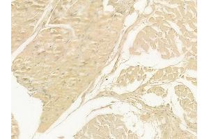 ABIN6262540 and ABIN6278895 at 1/100 staining human tongue carcinoma by IHC-P.