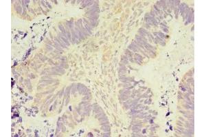 Immunohistochemistry of paraffin-embedded human ovarian cancer using ABIN7165911 at dilution of 1:100 (PELO Antikörper  (AA 1-385))