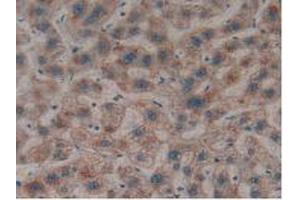 IHC-P analysis of Human Liver Cancer Tissue, with DAB staining. (LGALS8 Antikörper  (AA 1-317))