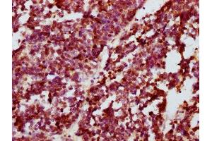 IHC image of ABIN7127685 diluted at 1:100 and staining in paraffin-embedded human lung cancer performed on a Leica BondTM system. (Rekombinanter CREB1 Antikörper  (pSer133))