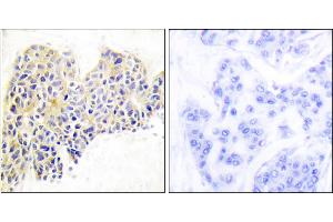 Immunohistochemical analysis of paraffin-embedded human breast carcinoma tissue using HSP90B (Ab-254) antibody. (HSP90AB1 Antikörper)