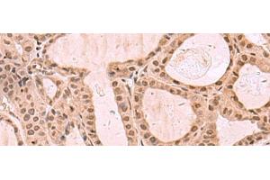 Immunohistochemistry of paraffin-embedded Human thyroid cancer tissue using KDM7A Polyclonal Antibody at dilution of 1:35(x200) (JHDM1D Antikörper)