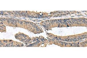 Immunohistochemistry of paraffin-embedded Human colorectal cancer tissue using ZG16 Polyclonal Antibody at dilution of 1:95(x200) (ZG16 Antikörper)