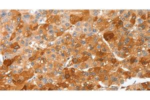 Immunohistochemistry of paraffin-embedded Human liver cancer using CIDEC Polyclonal Antibody at dilution of 1:50