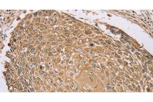 Immunohistochemistry of paraffin-embedded Human lung cancer tissue using RNF148 Polyclonal Antibody at dilution 1:45 (RNF148 Antikörper)