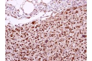 IHC-P Image Immunohistochemical analysis of paraffin-embedded ES2 xenograft, using ERCC2, antibody at 1:500 dilution. (ERCC2 Antikörper  (Internal Region))