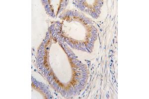 Formalin-fixed and paraffin-embedded human colon carcinoma tissue reacted with GDF11 antibody (N-term) (ABIN388814 and ABIN2839133) , which was peroxidase-conjugated to the secondary antibody, followed by DAB staining. (GDF11 Antikörper  (N-Term))